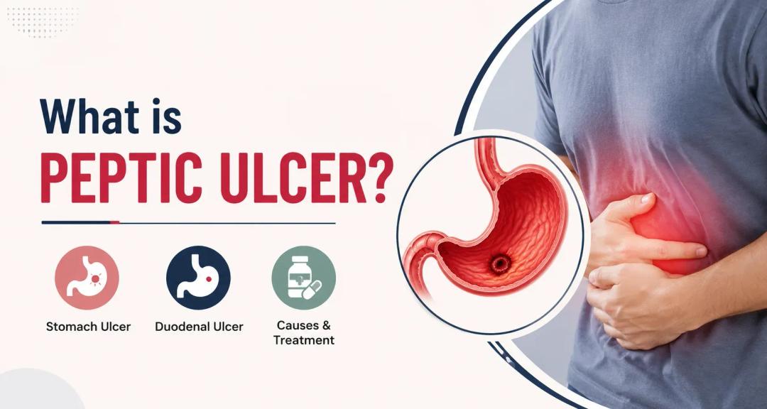 What is Peptic Ulcer