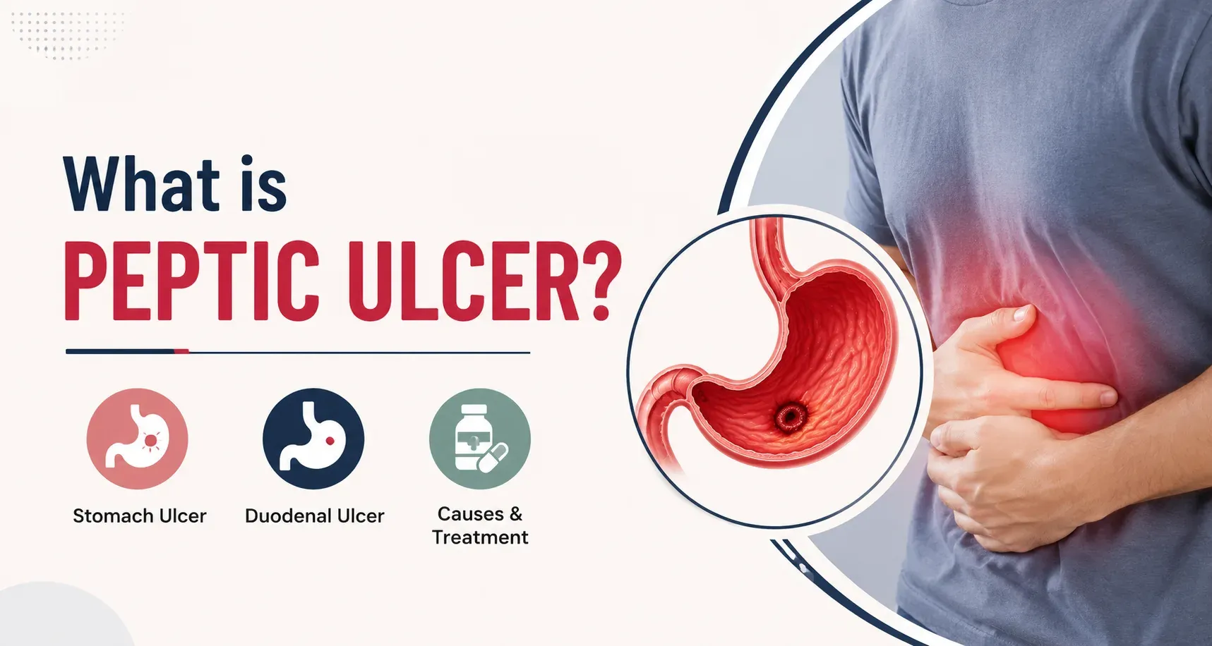 What is Peptic Ulcer
